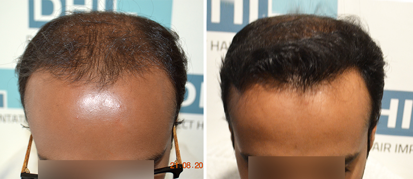 DHI before & after hair transplant results